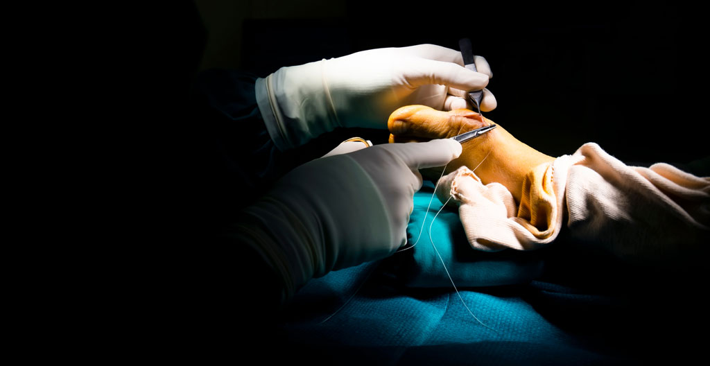 Illustration schématique comparant chirurgie classique et mini-invasive de l'hallux valgus